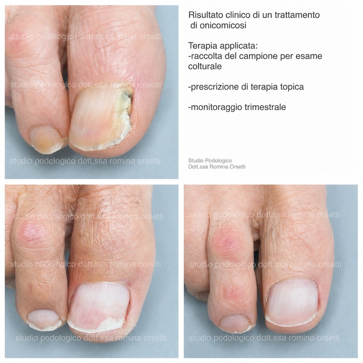Onicomicosi &ndash; foto 10