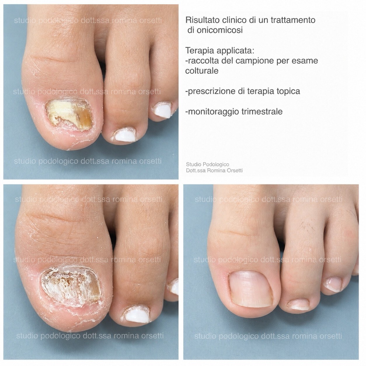 Onicomicosi &ndash; foto 11