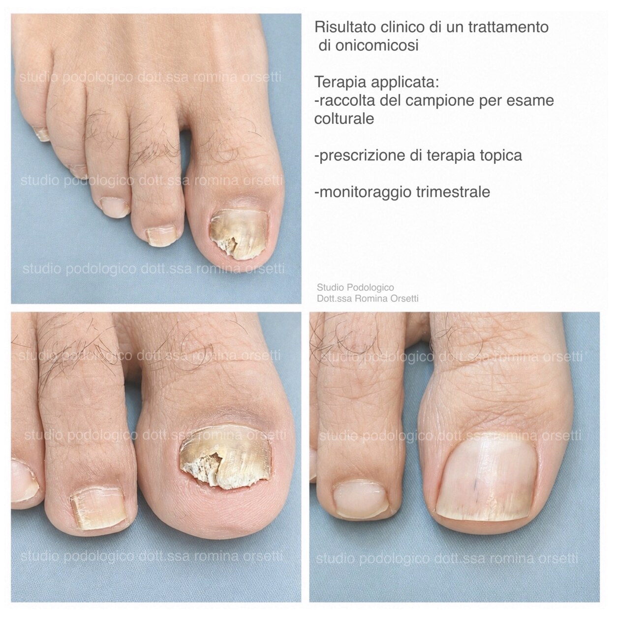 Onicomicosi &ndash; foto 5
