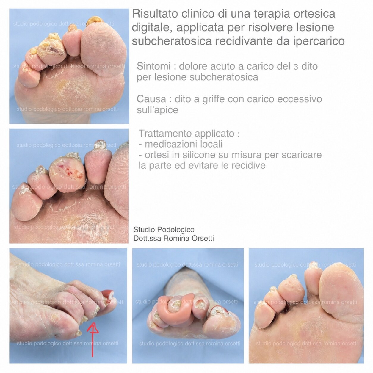 Ortesi digitali in silicone &ndash; foto 1