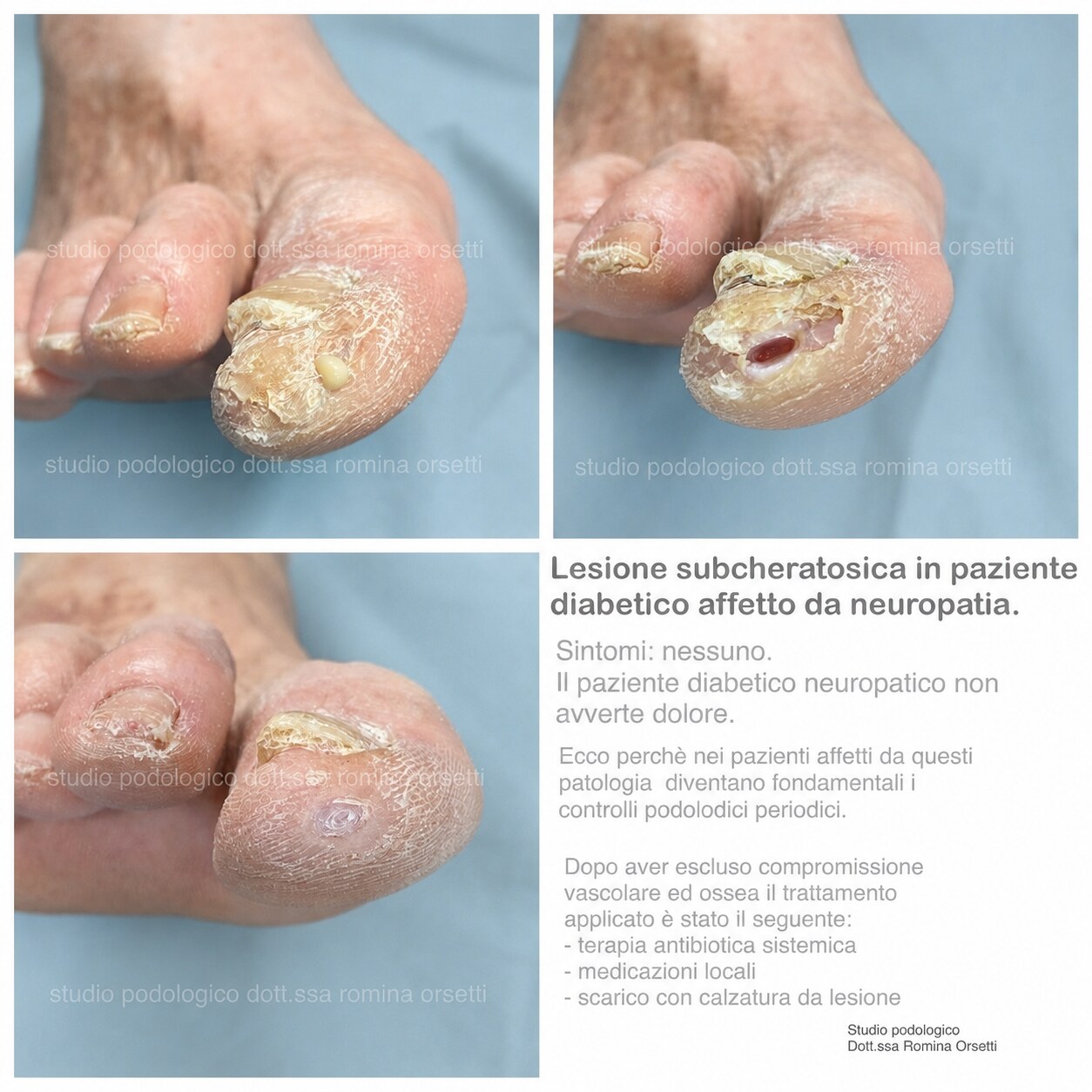 Piede diabetico &ndash; foto 1