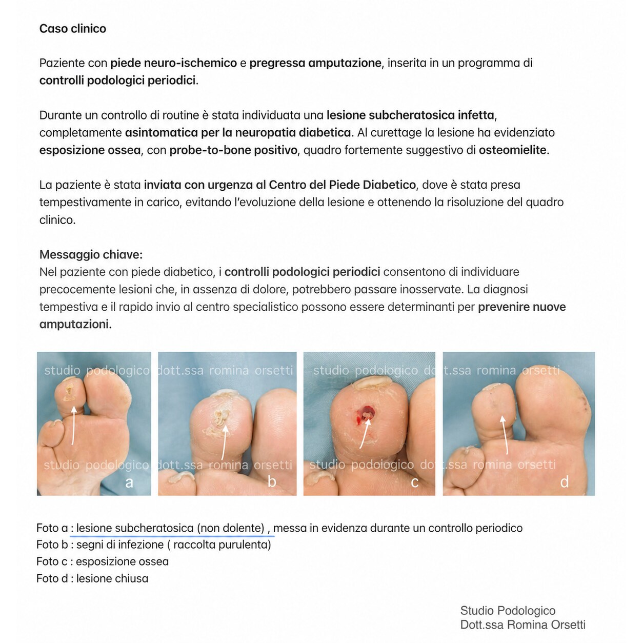 Piede diabetico &ndash; foto 4
