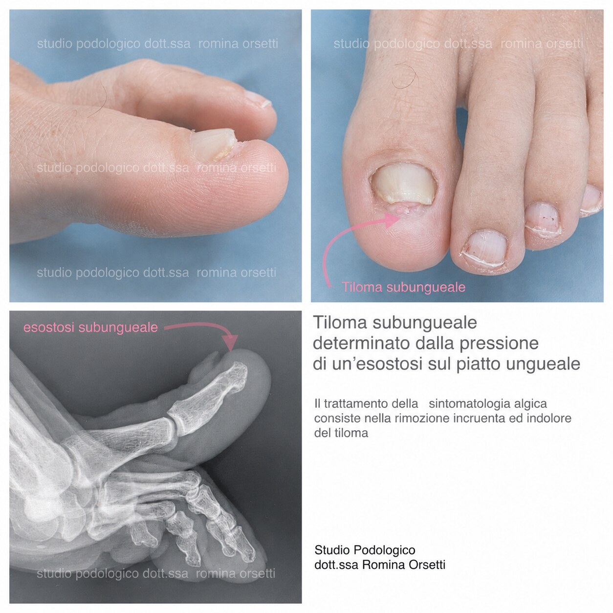 Tiloma subungueale &ndash; foto 1