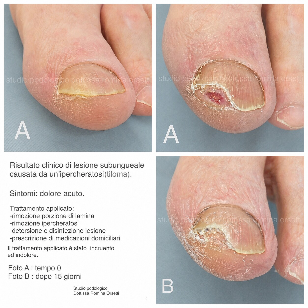 Tiloma subungueale &ndash; foto 2