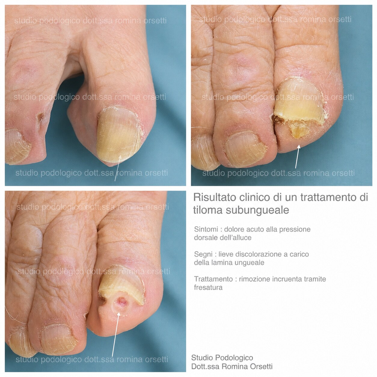 Tiloma subungueale &ndash; foto 4