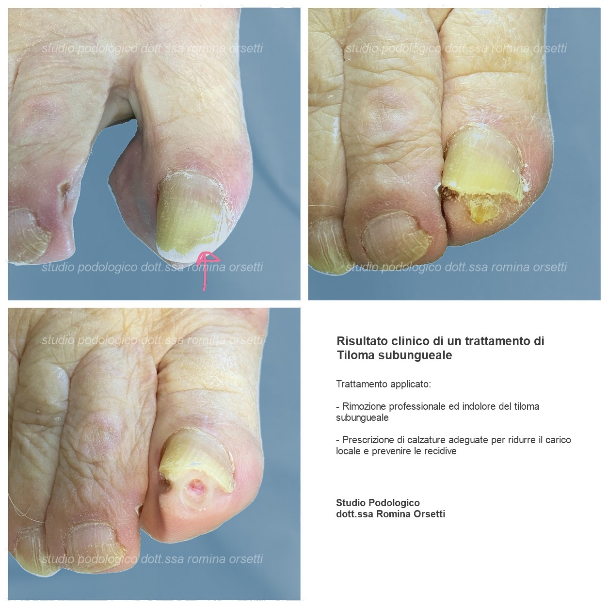 Tiloma subungueale &ndash; foto 1
